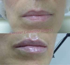 l'acide hyaluronique pour des lèvres plus pulpeuses