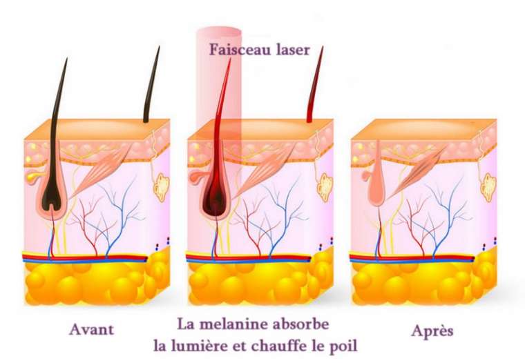 L'epilation laser du corps et du visage avec un laser Alexandrite NDYag